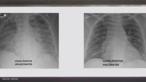 الصور الأولى (يمين) لرئتي شخص ملقح والثانية لشخص غير ملقح